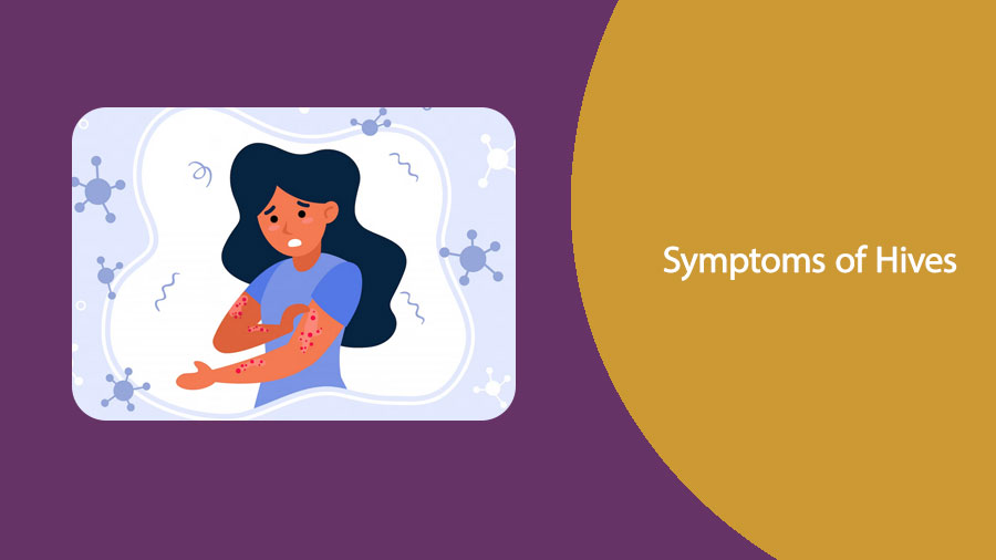 Symptoms of Hives