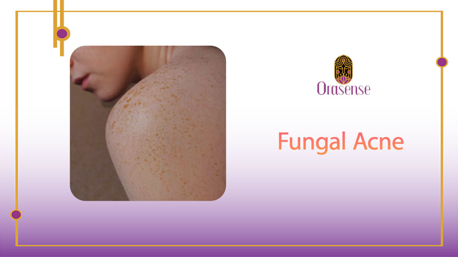 Fungal Acne