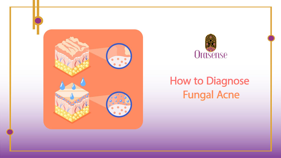 How to Diagnose Fungal Acne
